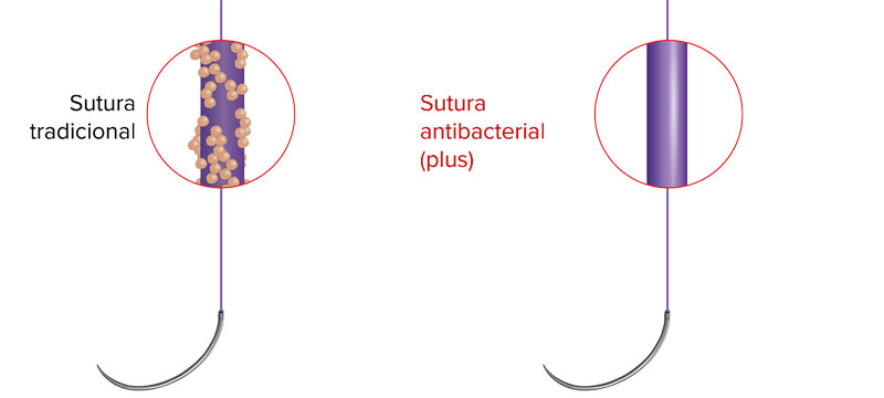 suturas antibacteriales plus