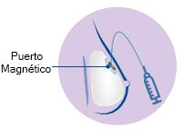 Qué esperar con los expansores de tejido